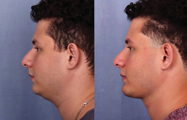 Before and After Image: Chin Surgery, Submentoplasty - left-side