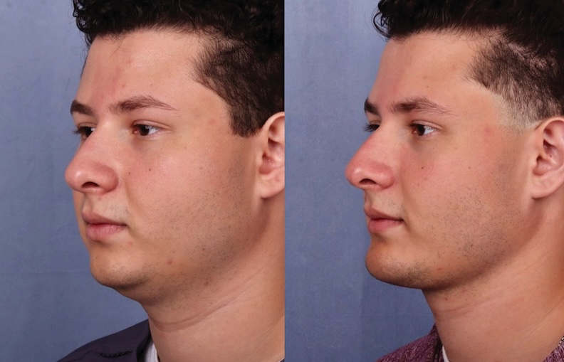 Before and After Image: Chin Surgery, Submentoplasty - left-front-oblique