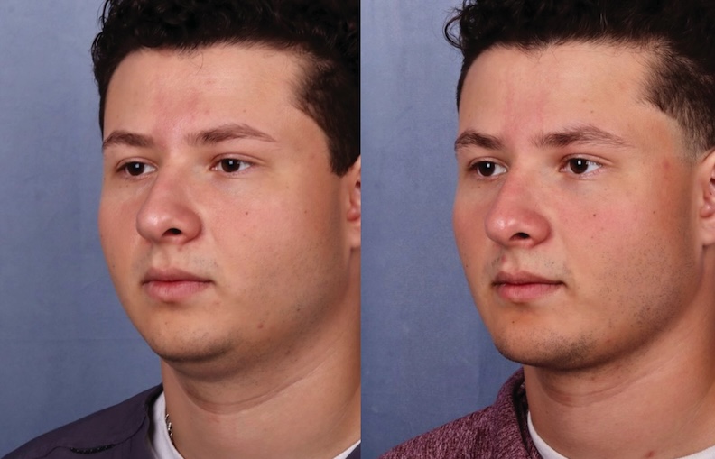 Before and After Image: Chin Surgery, Submentoplasty - left-front-oblique
