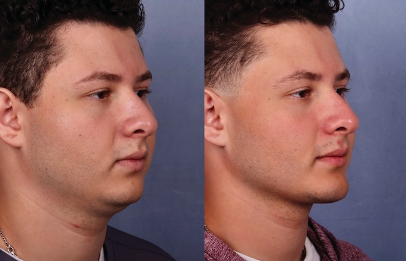 Before and After Image: Chin Surgery, Submentoplasty - right-front-oblique
