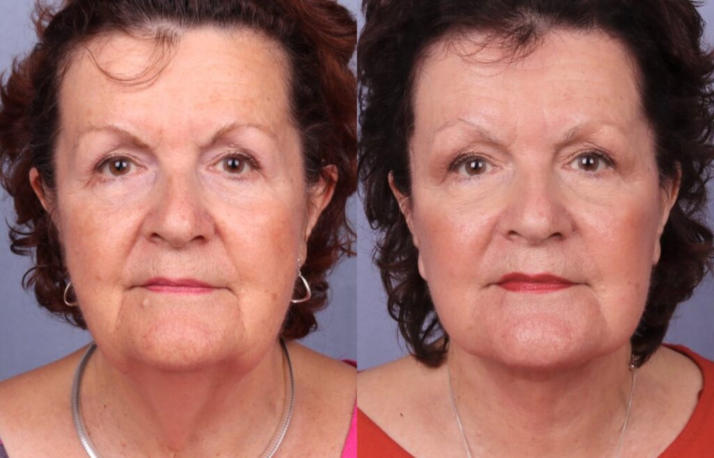 Before and After Image: Facelift & Neck Lift - front