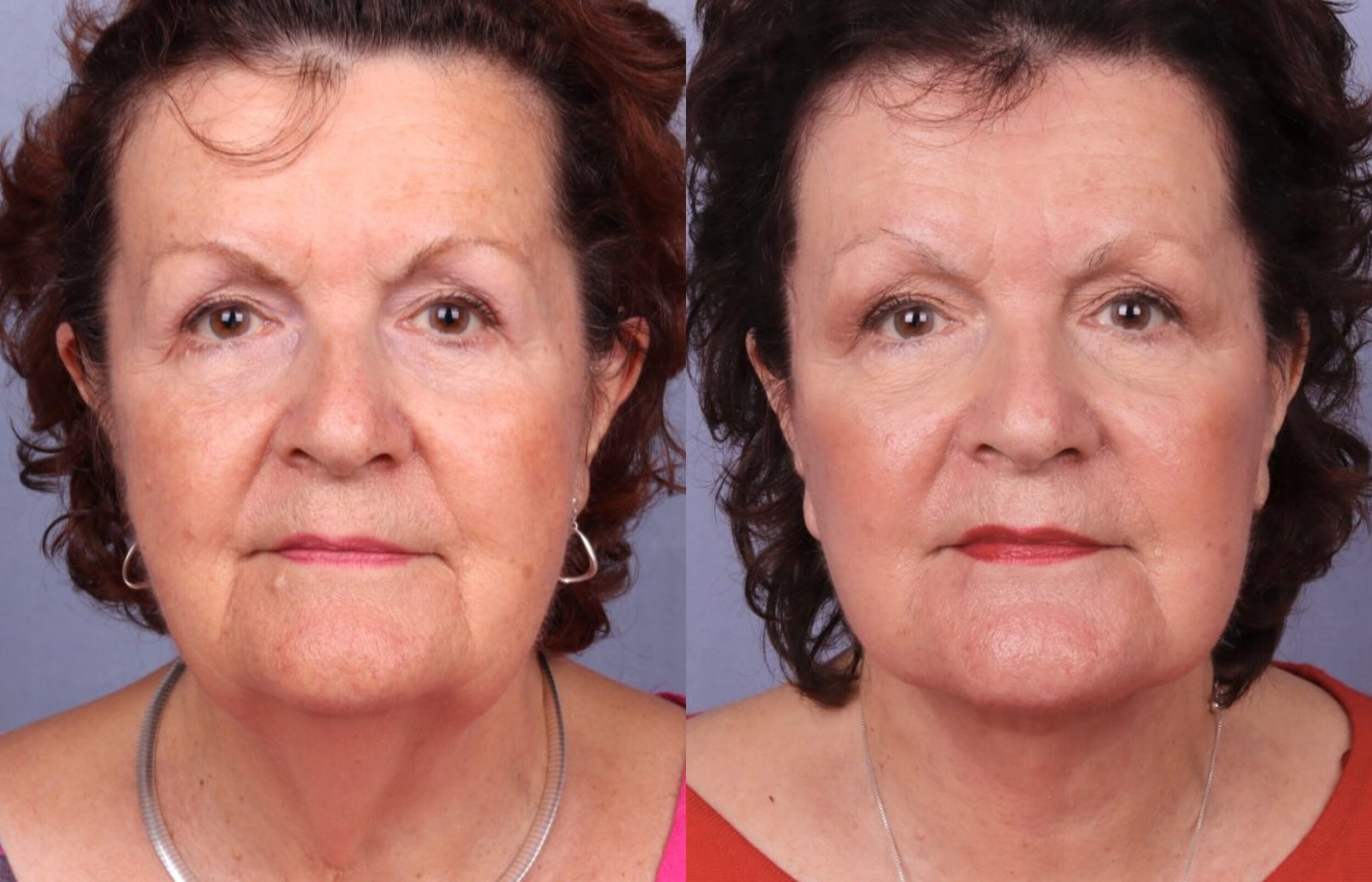 Before and After Image: Facelift & Neck Lift - front