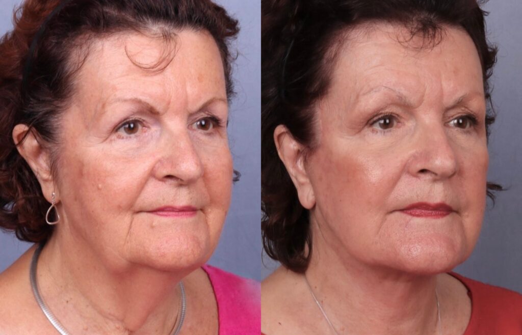 Before and After Image: Facelift & Neck Lift - right-front-oblique
