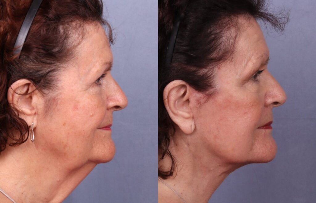 Before and After Image: Facelift & Neck Lift - right-side