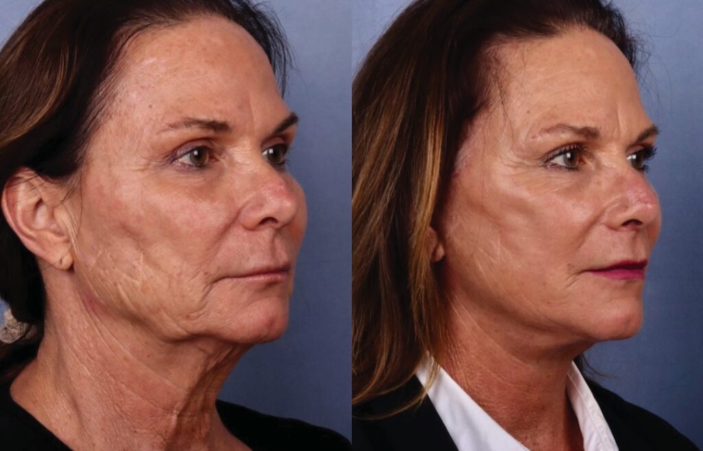 Before and After Image: Facelift & Neck Lift - right-front-oblique