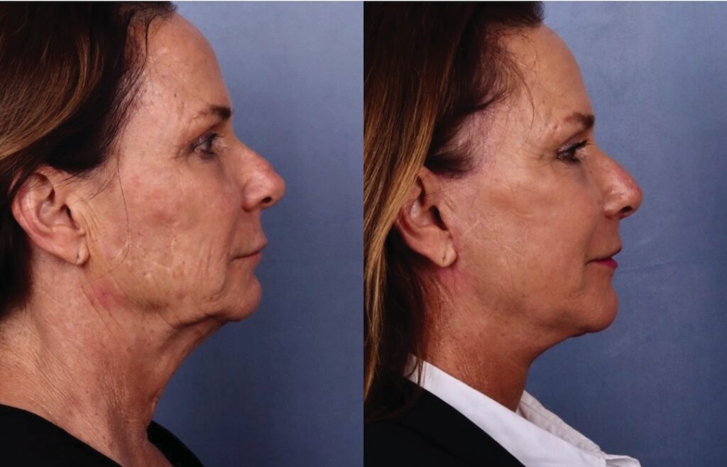 Before and After Image: Facelift & Neck Lift - right-side