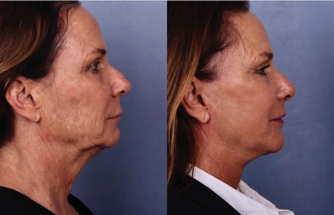Before and After Image: Facelift & Neck Lift - right-side