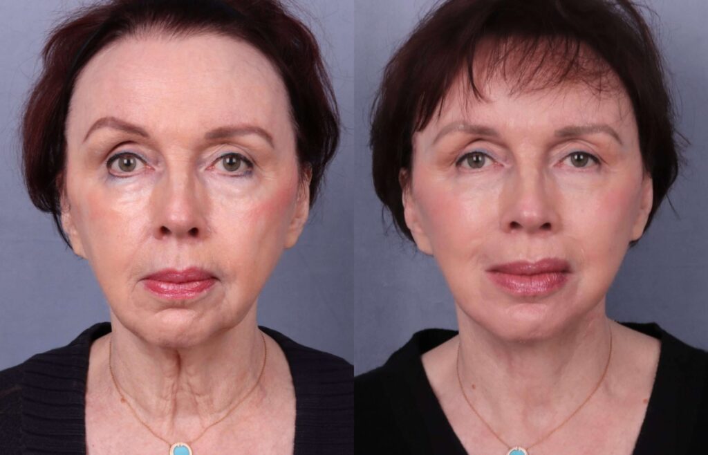 Before and After Image: Facelift & Neck Lift - front