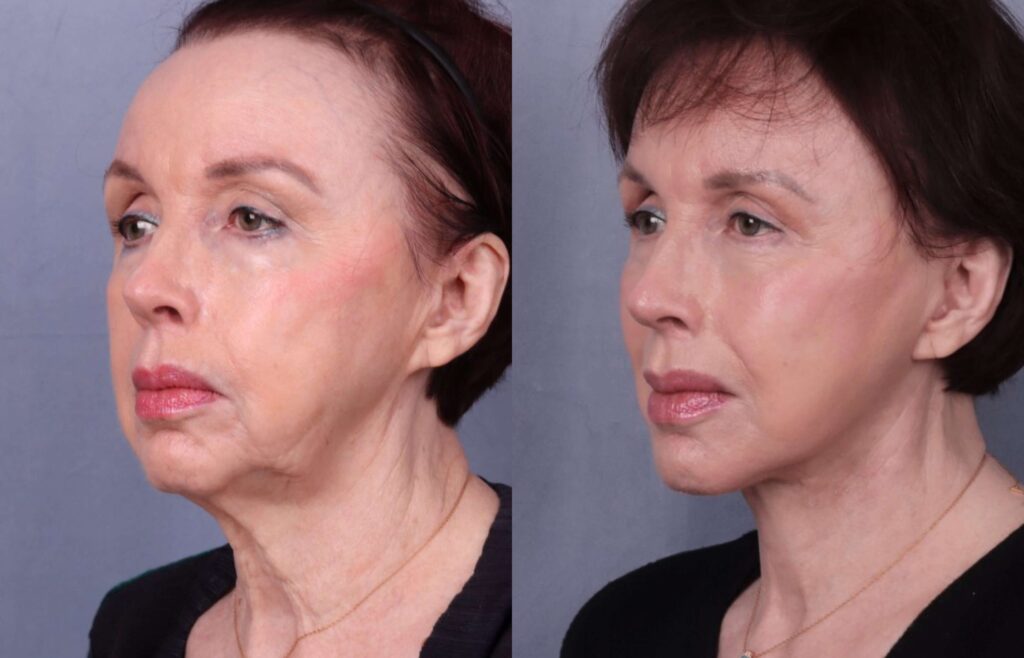 Before and After Image: Facelift & Neck Lift - left-front-oblique