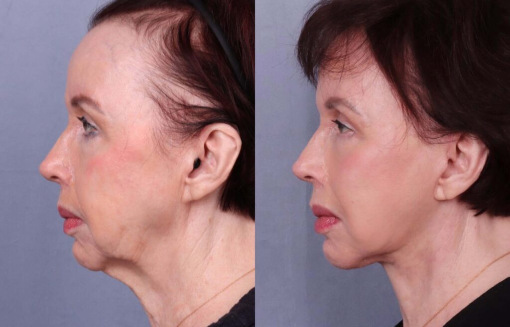 Before and After Image: Facelift & Neck Lift - left-side