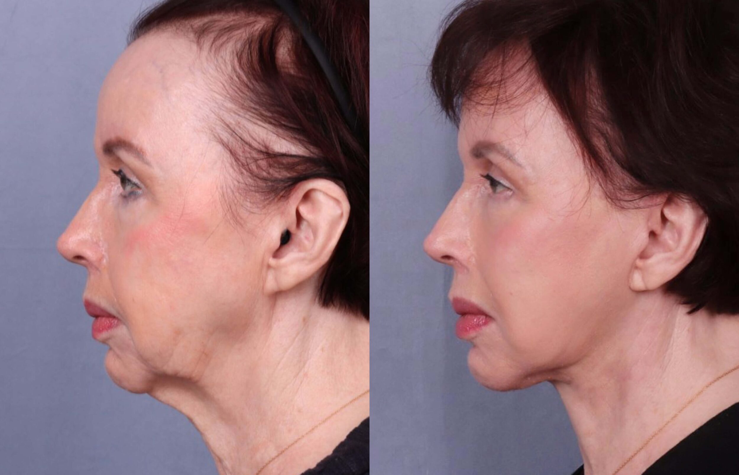 Before and After Image: Facelift & Neck Lift - left-side