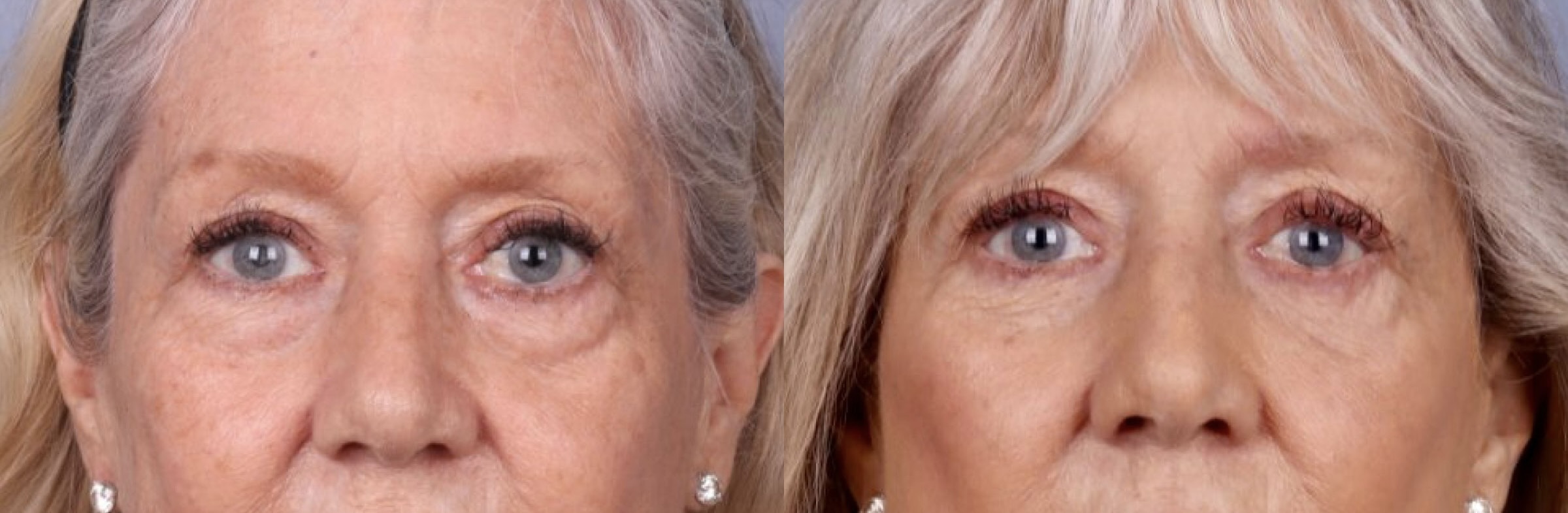 Before and After Image: Upper & Lower Blepharoplasty - front