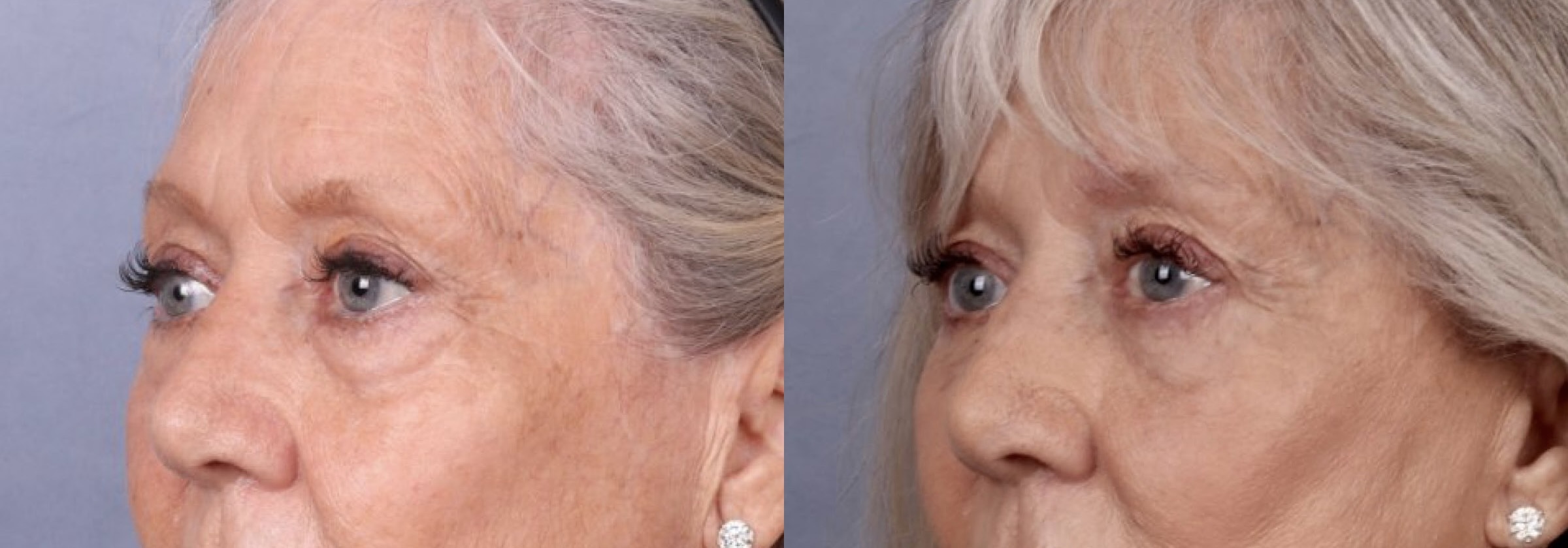 Before and After Image: Upper & Lower Blepharoplasty - left-front-oblique