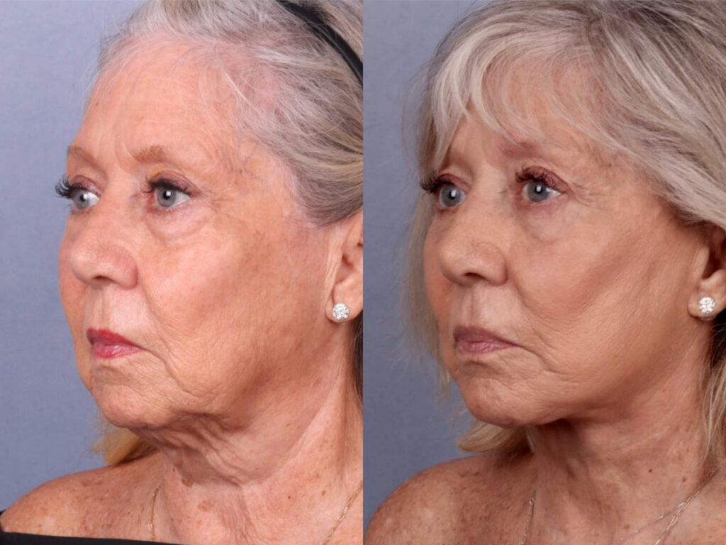 Before and After Image: Facelift & Neck Lift - left-front-oblique