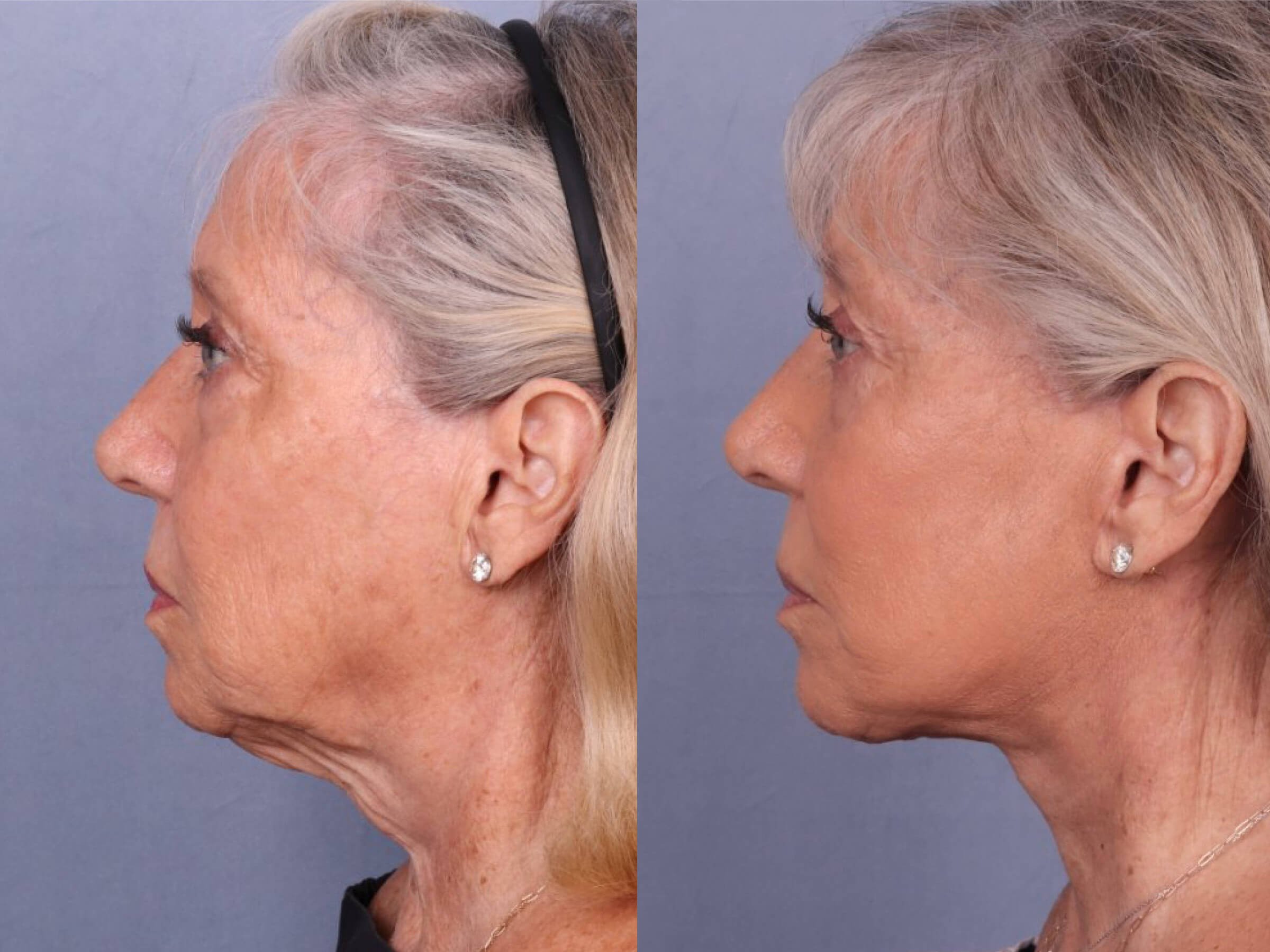 Before and After Image: Facelift & Neck Lift - left-side