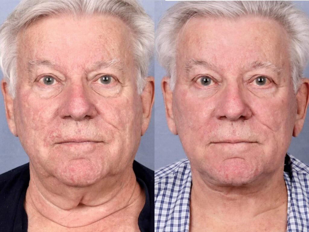 Before and After Image: Facelift & Neck Lift - front