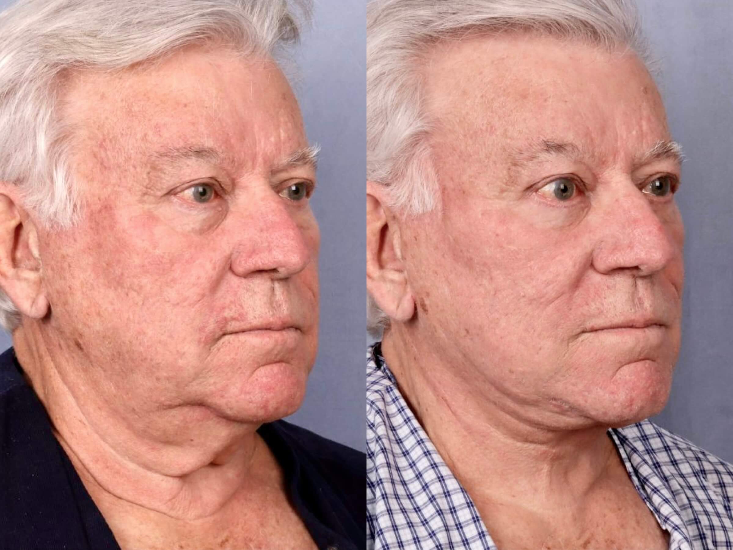 Before and After Image: Facelift & Neck Lift - right-front-oblique