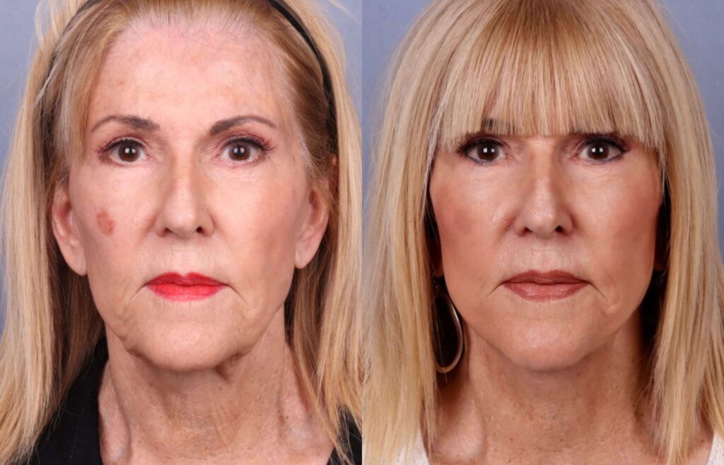 Before and After Image: Facelift & Neck Lift - front