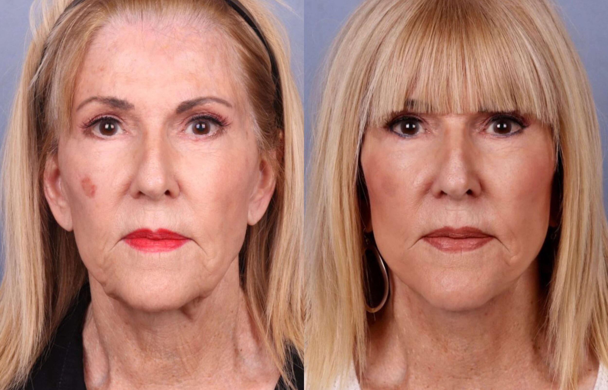 Before and After Image: Facelift & Neck Lift - front