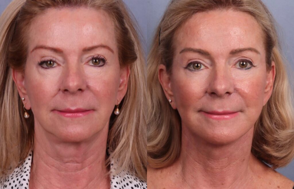 Before and After Image: Facelift & Neck Lift - front