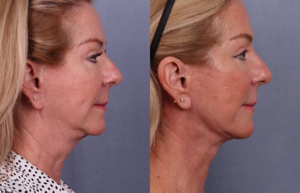 Before and After Image: Facelift & Neck Lift - right-side