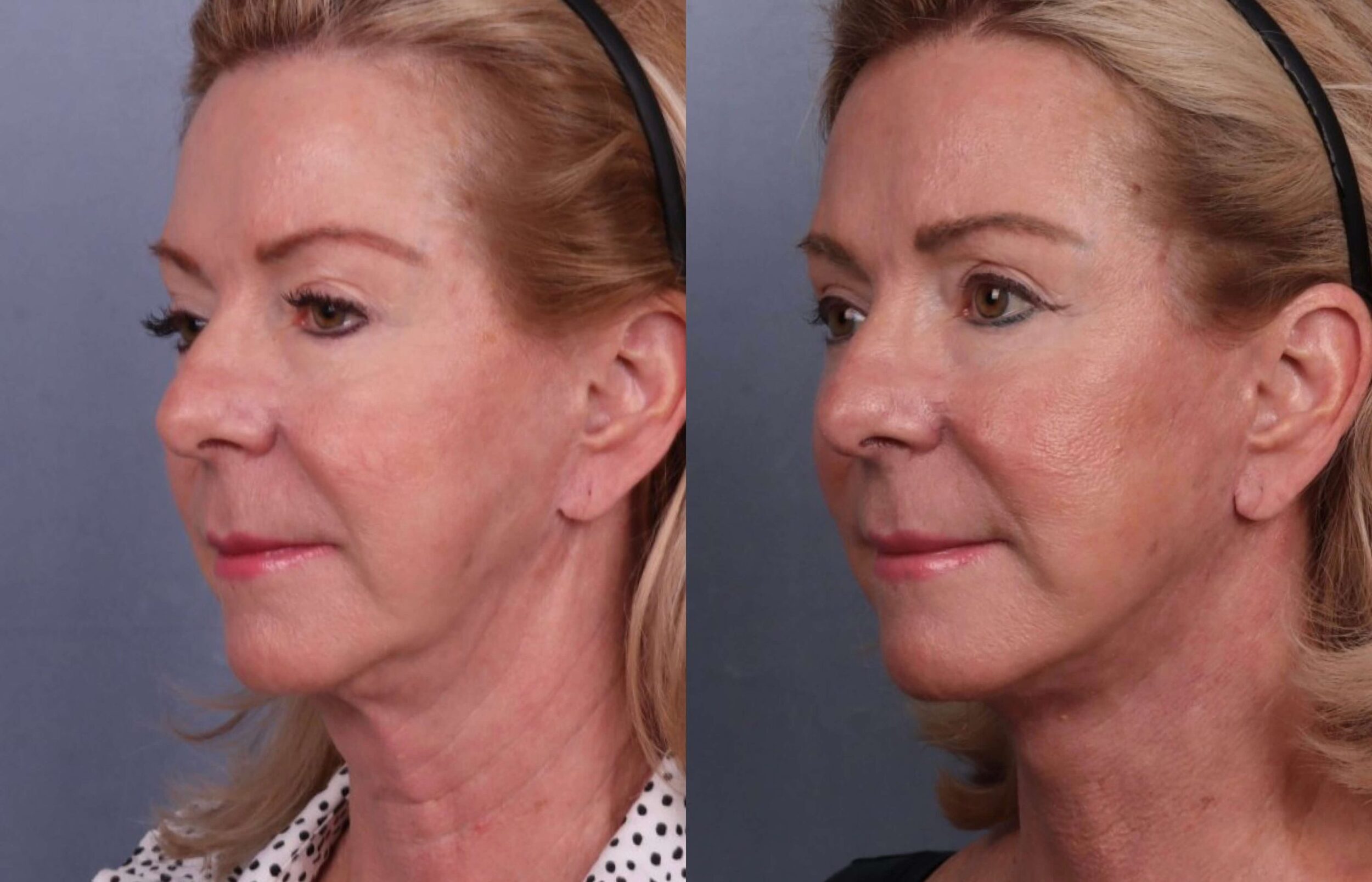 Before and After Image: Facelift & Neck Lift - left-front-oblique