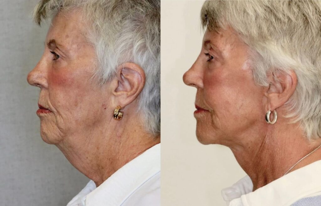 Before and After Image: Facelift & Neck Lift - left-side