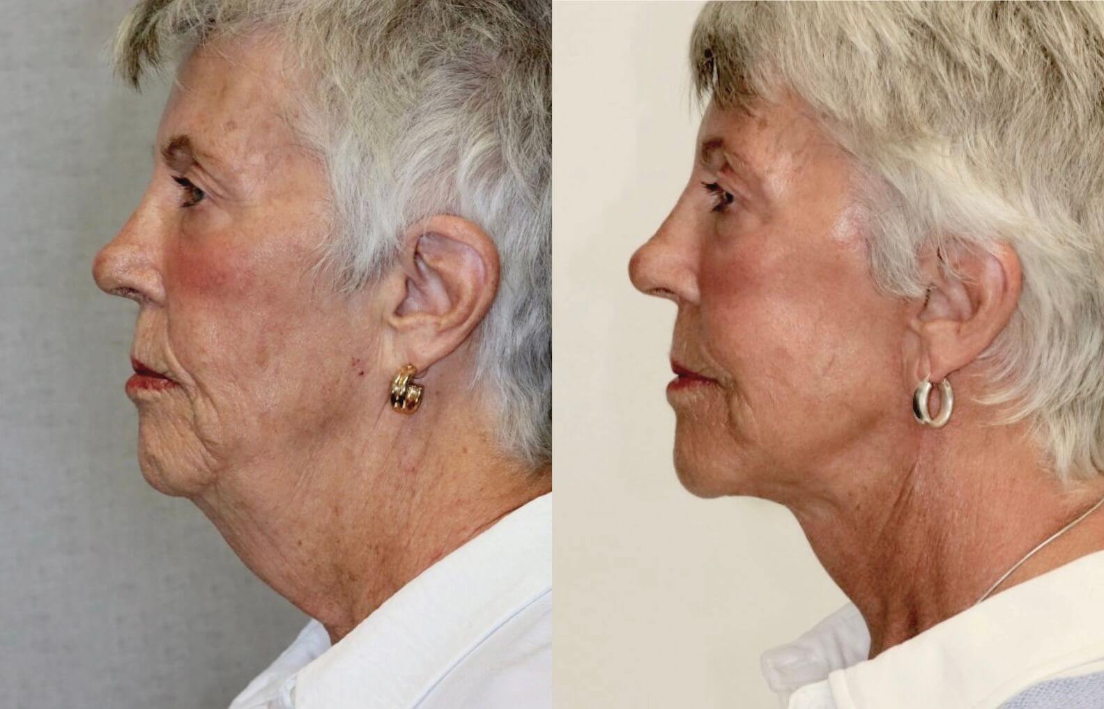 Before and After Image: Facelift & Neck Lift - left-side