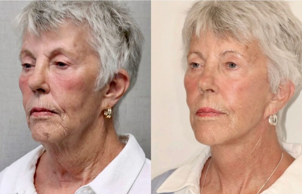 Before and After Image: Facelift & Neck Lift - left-front-oblique