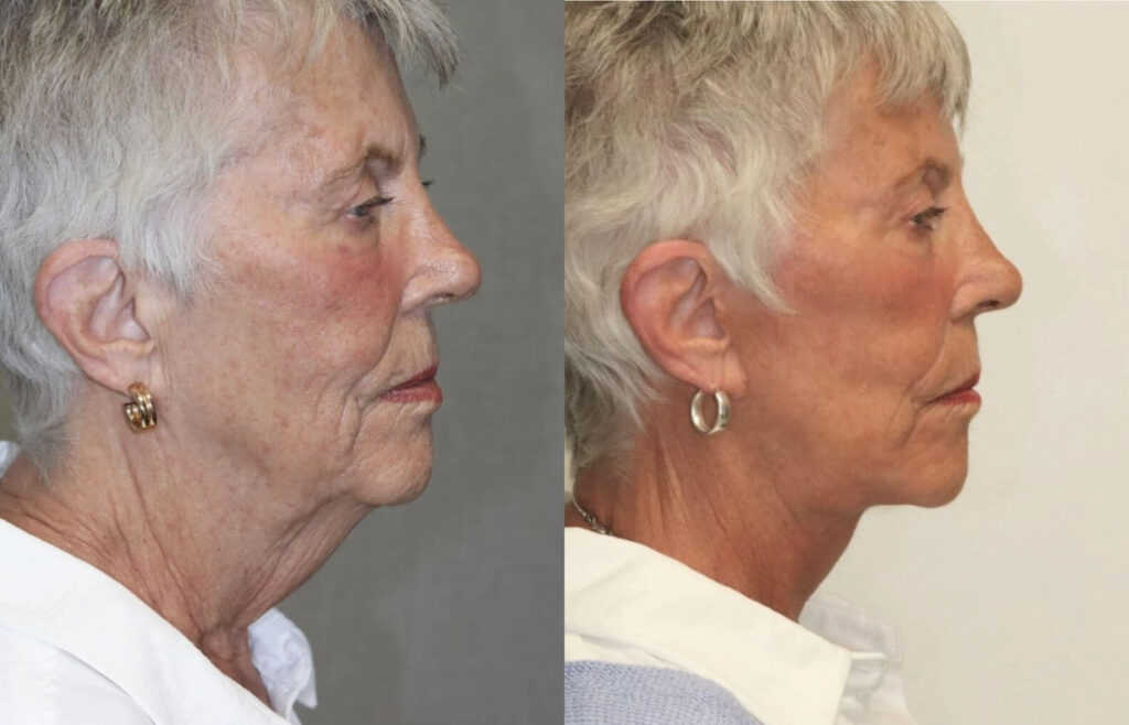 Before and After Image: Facelift & Neck Lift - right-side