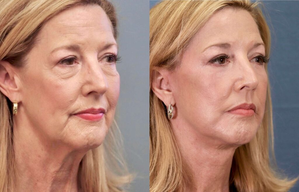 Before and After Image: Facelift & Neck Lift - right-front-oblique