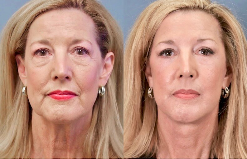 Before and After Image: Facelift & Neck Lift - front