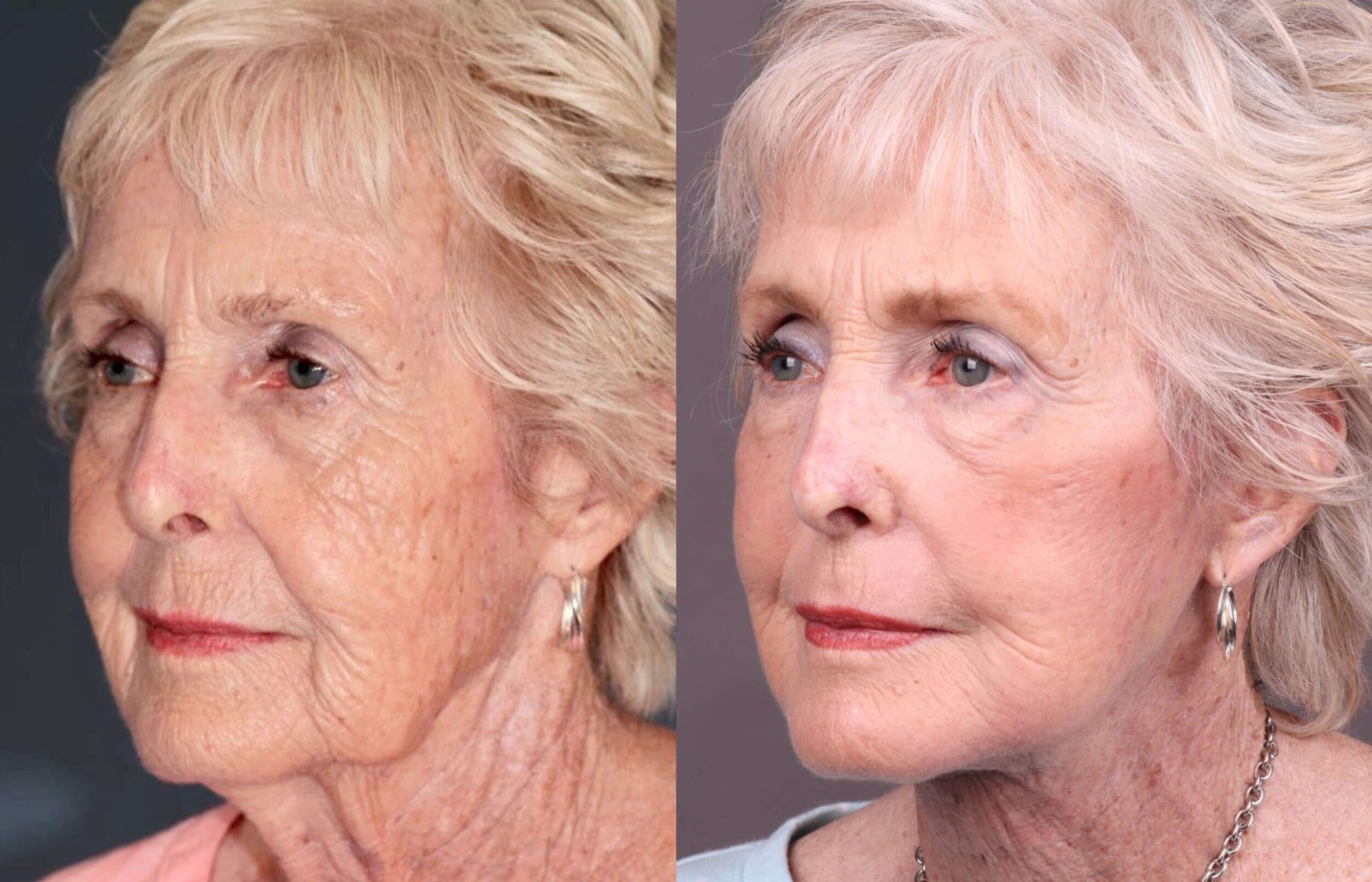 Before and After Image: Facelift & Neck Lift - left-front-oblique