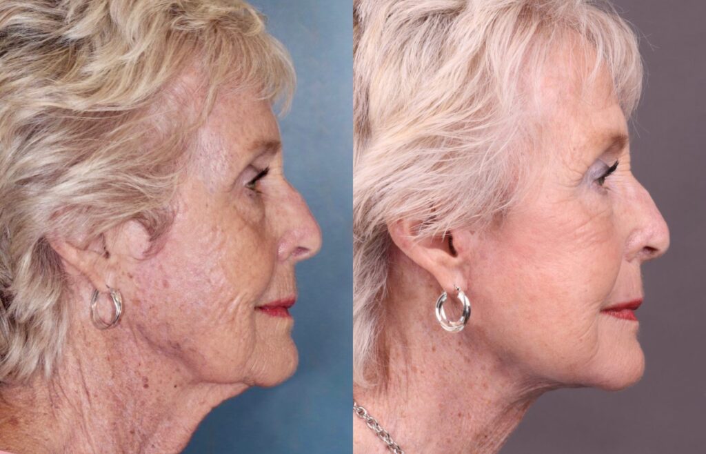 Before and After Image: Facelift & Neck Lift - right-side