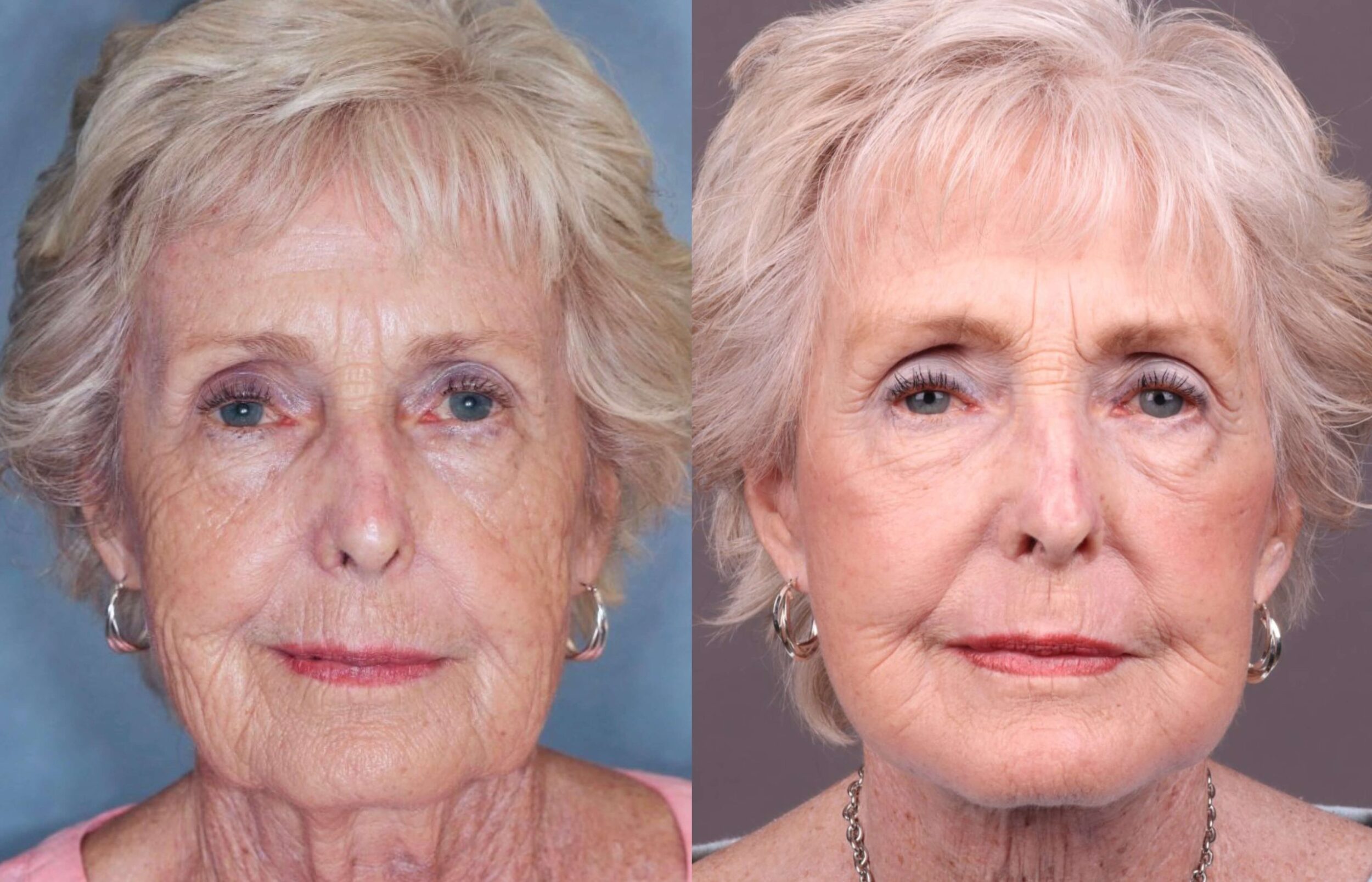 Before and After Image: Facelift & Neck Lift - front