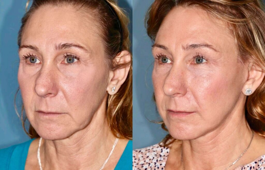 Before and After Image: Facelift & Neck Lift - left-front-oblique