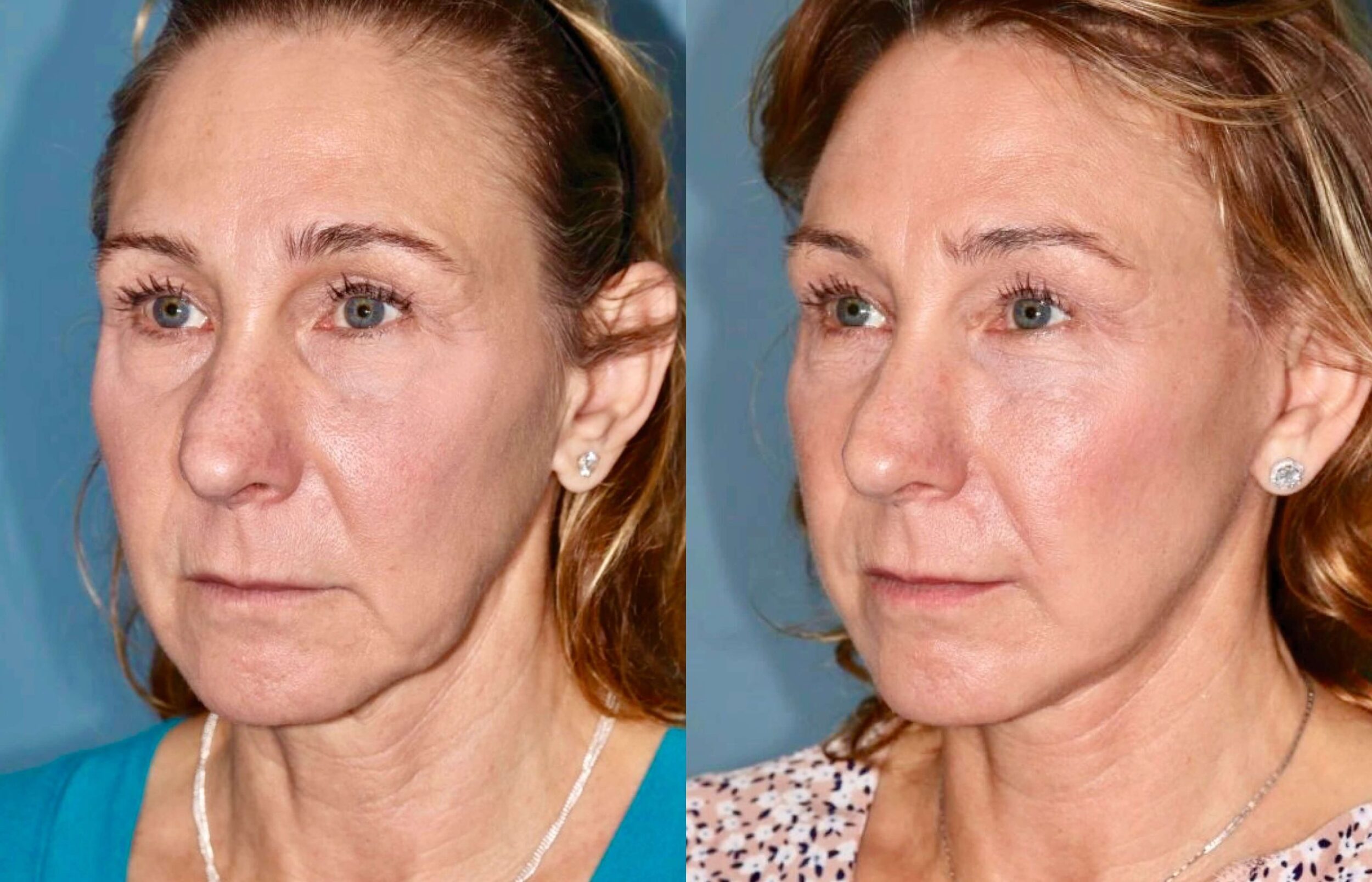 Before and After Image: Facelift & Neck Lift - left-front-oblique