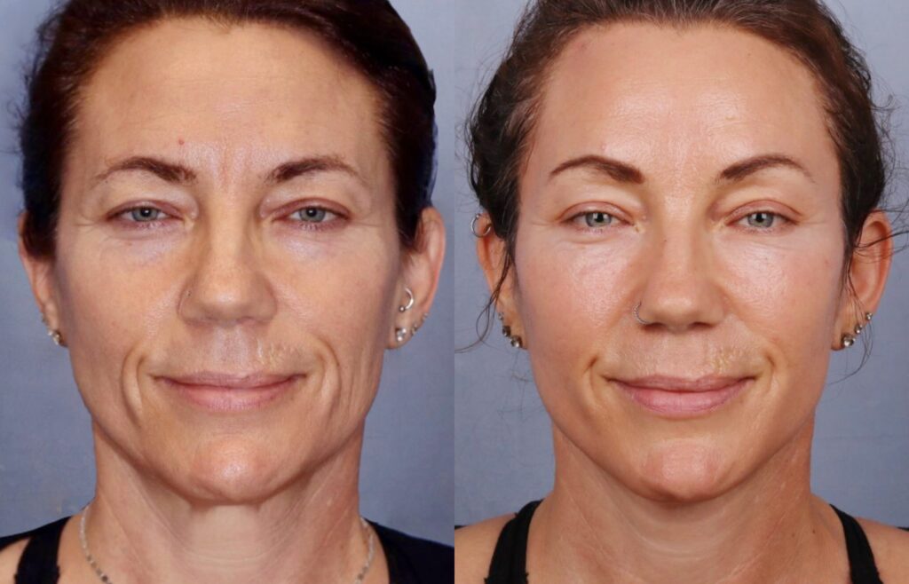 Before and After Image: Facelift & Neck Lift - front