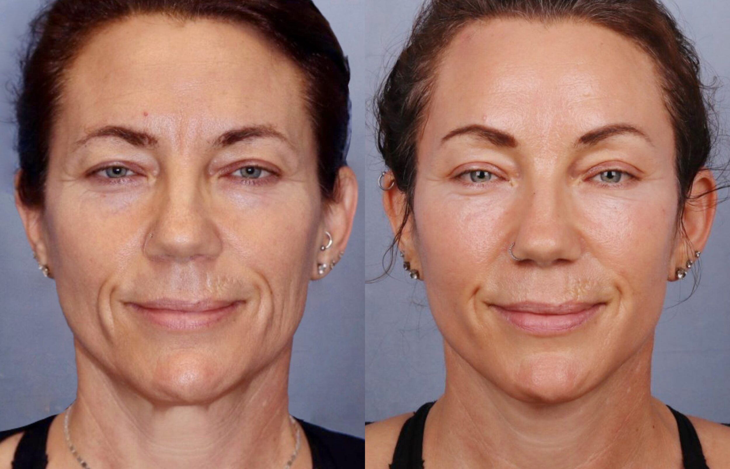 Before and After Image: Facelift & Neck Lift - front