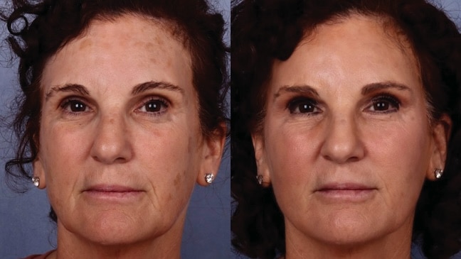 Before and After Image: Facial Volume Enhancement - front