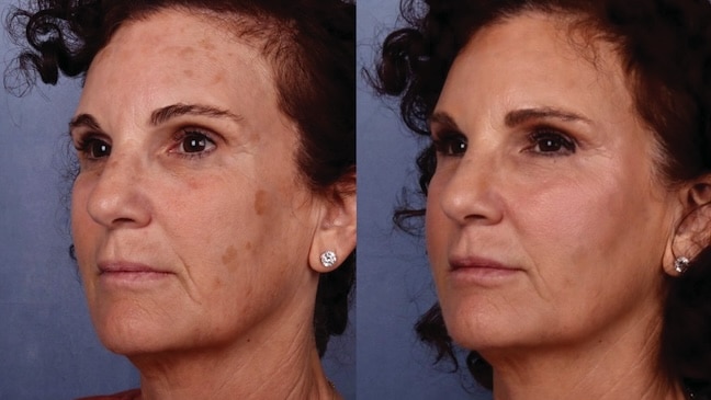 Before and After Image: Facial Volume Enhancement - left-front-oblique