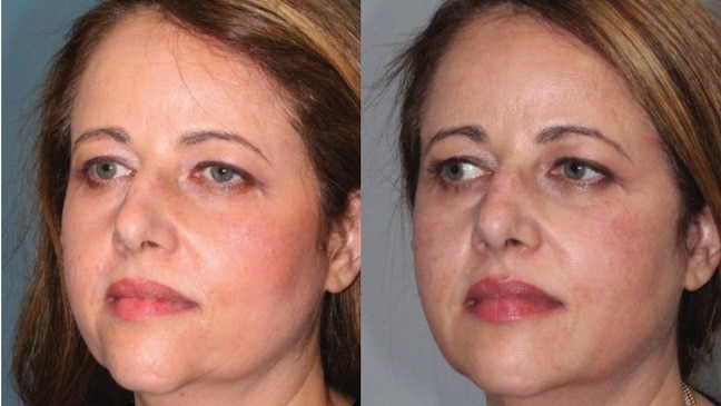 Before and After Image: Facial Volume Enhancement - left-front-oblique