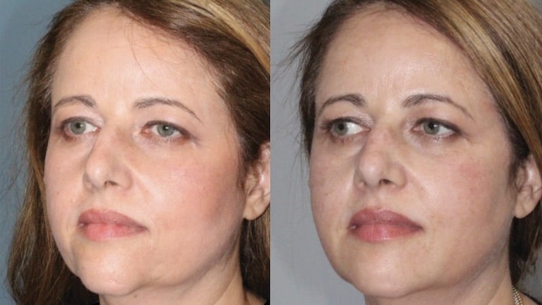 Before and After Image: Botox & Fillers - left-front-oblique