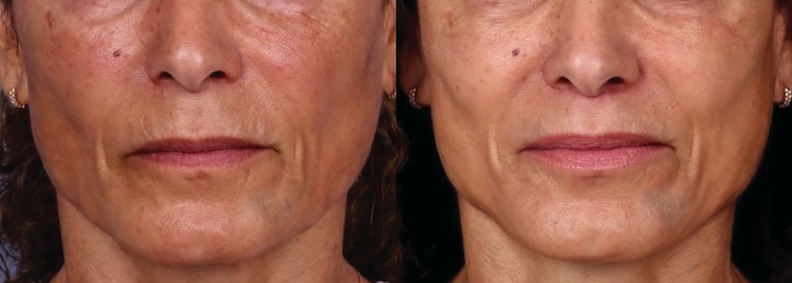 Before and After Image: Lip Lift - front