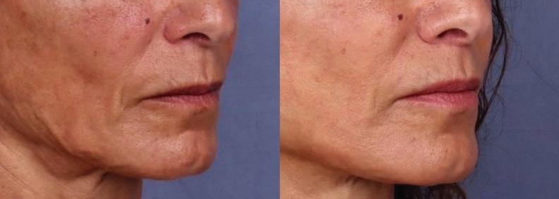 Before and After Image: Lip Lift - right-front-oblique