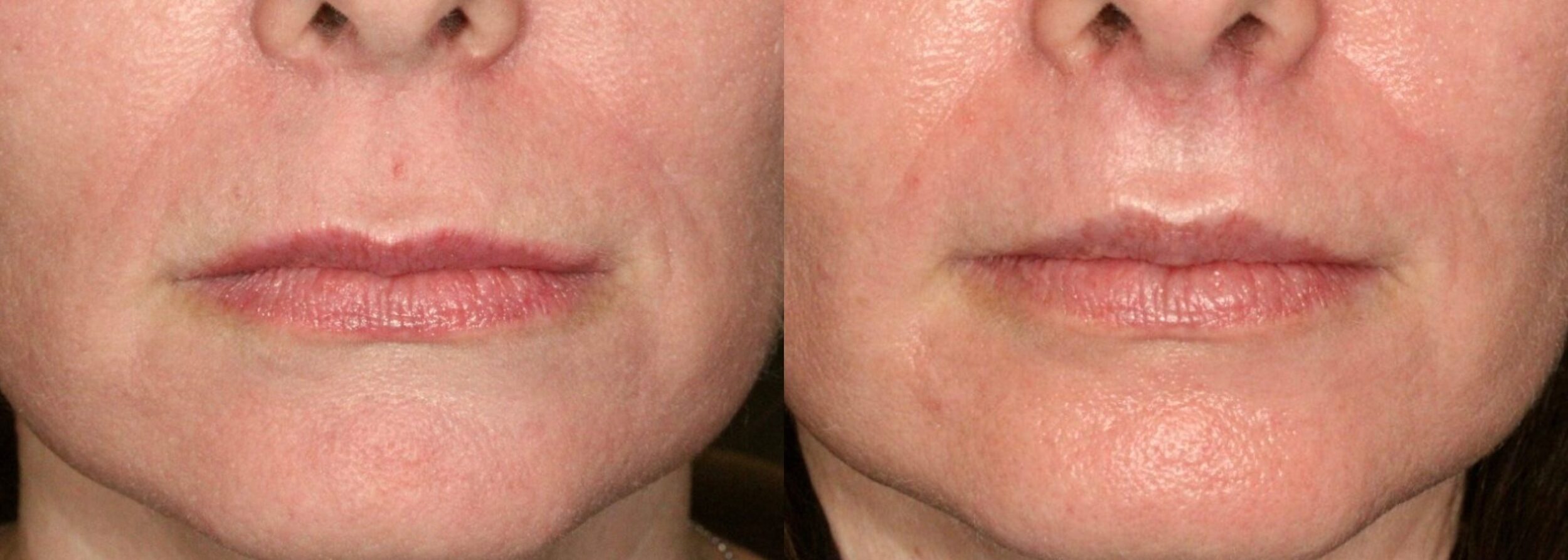 Before and After Image: Lip Lift - front