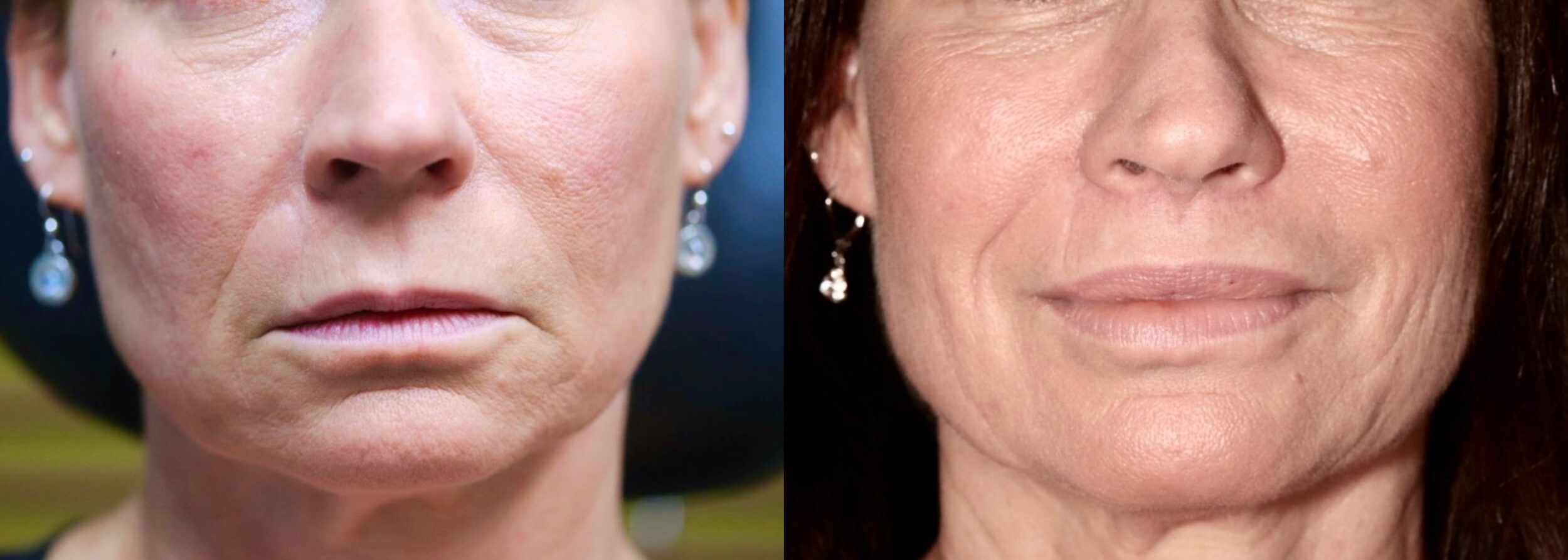 Before and After Image: Lip Lift - front