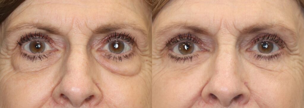 Before and After Image: Lower Blepharoplasty - front