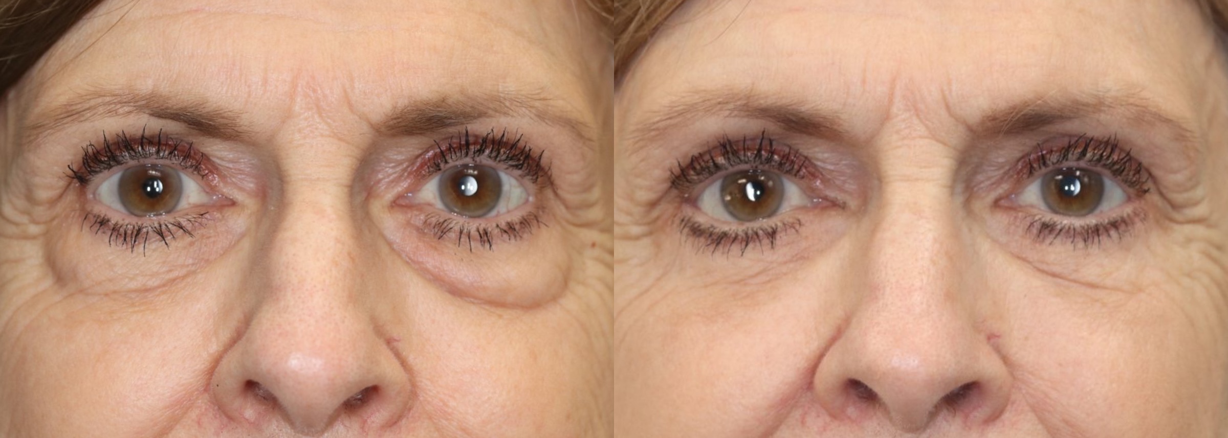 Before and After Image: Lower Blepharoplasty - front