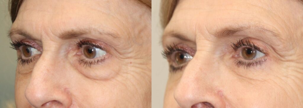 Before and After Image: Lower Blepharoplasty - left-front-oblique